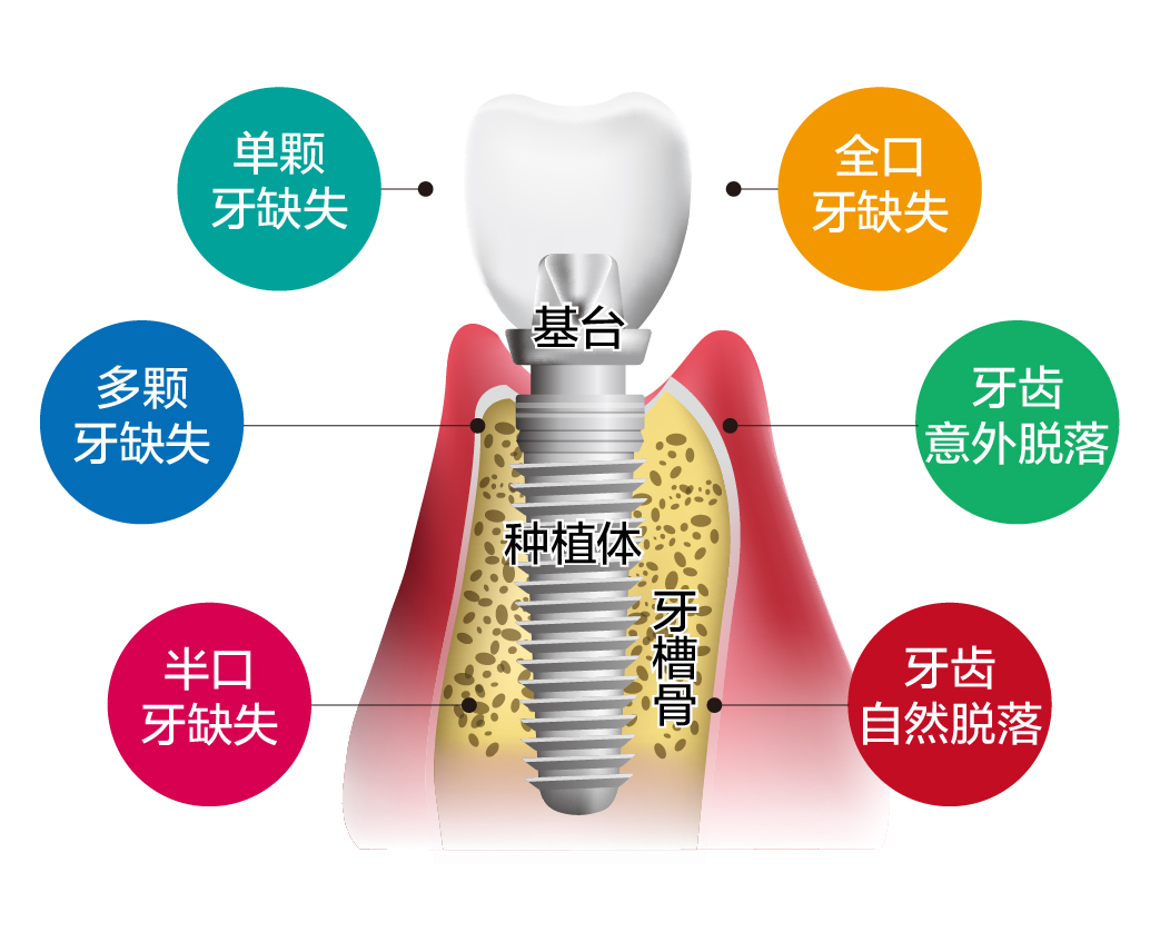 中国第一例EB全口种植牙全记录（四） - 知乎