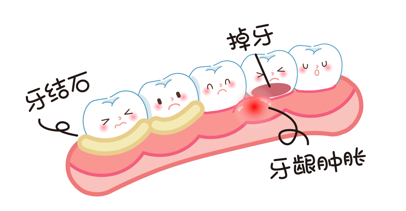 牙根鼓小包，感染深入骨！_牙龈